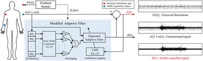 Real-time adaptive cancellation of TENS feedback artifact on sEMG for prosthesis closed-loop control